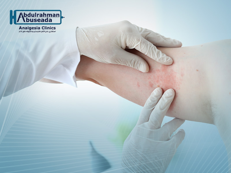 علاج الحزام الناري