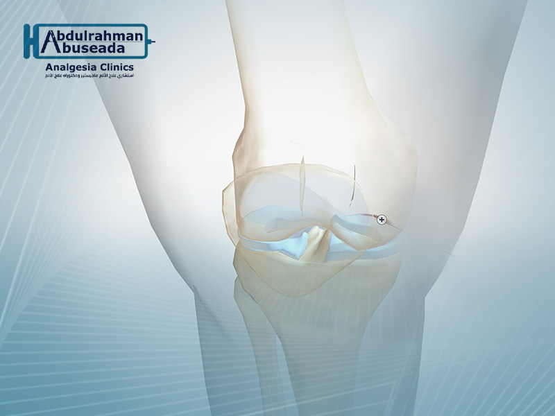 علاج خشونة مفصل الركبة