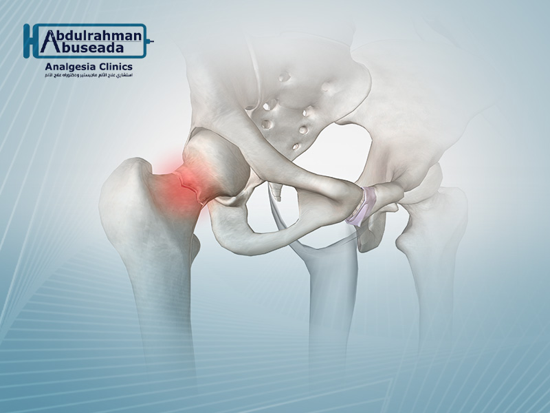 التهاب المفصل العجزي الحرقفي
